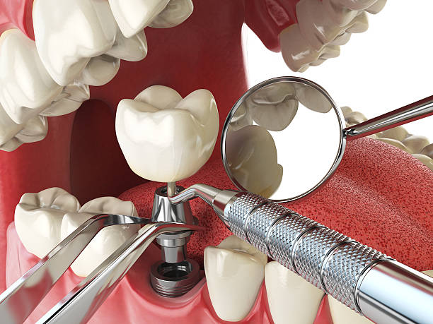 Best Knocked-Out Tooth (Avulsed Tooth) Treatment in Lathrup Village, MI